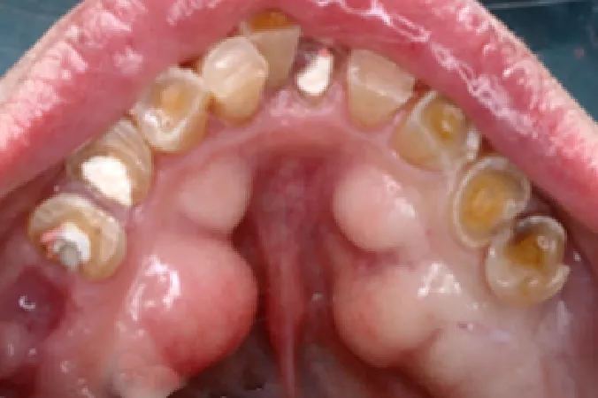 【症例4】歯ぎしりでダメージを負った歯を改善　審美治療＋インプラント